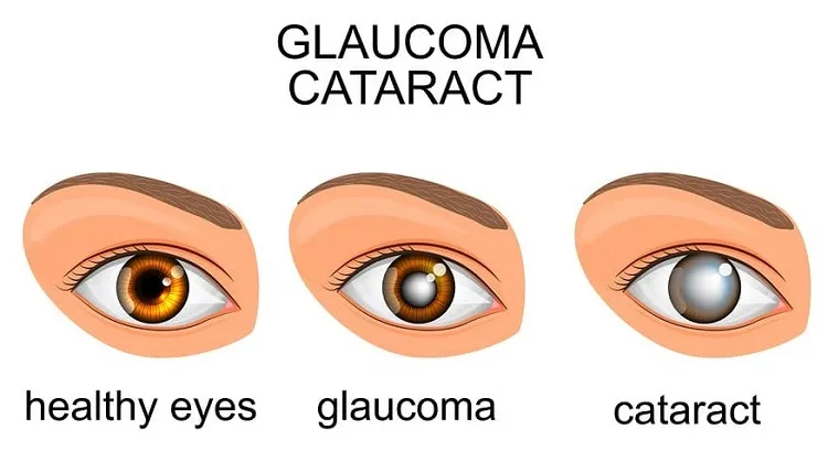 Healthy Eye Vs Glaucoma Vs Cataract