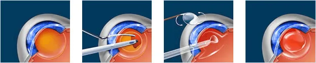 Procedure Of Laser Cataract Surgery
