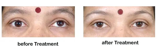 Squint Eye Treatment Before And After