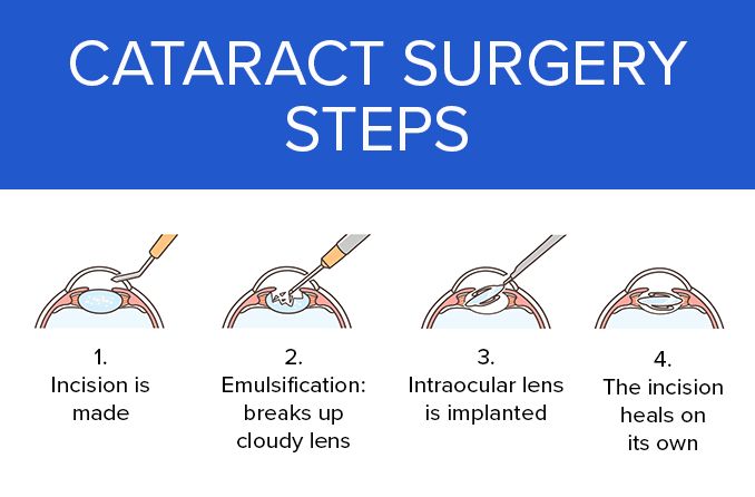 What Is Laser Cataract Surgery and Its Steps